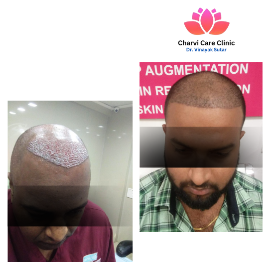 Hair Transplant