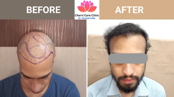 Hair Transplant Doctor Thane City