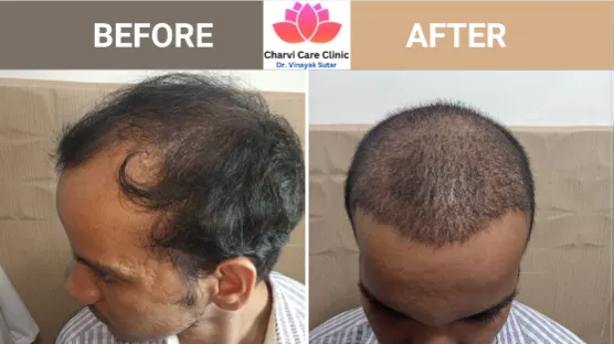 Hair Transplant Doctor Thane