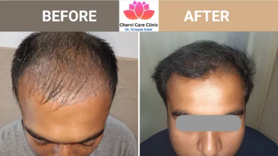 Hair Transplant Doctor
