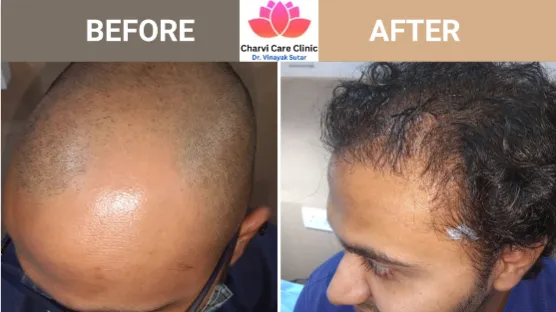 Hair Transplant Doctor Near Me